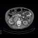Xanthogranulomatous pyelonephritis: CT - Computed tomography